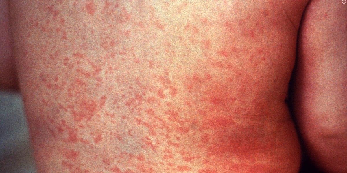 Person in federal custody in Pinal County has the measles, officials say - Featured Image