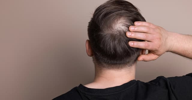 First long-acting hair regrowth pill hailed as 'new benchmark' - Featured Image